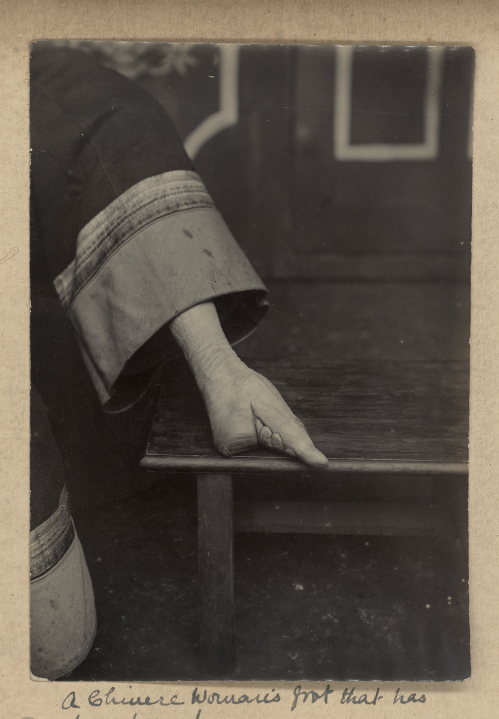 A Chinese Woman's Foot That Has Been Bound.