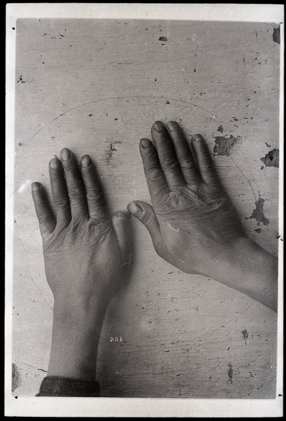 Yeung Tsung's Hands - Imaged Used to Disprove Leprosy