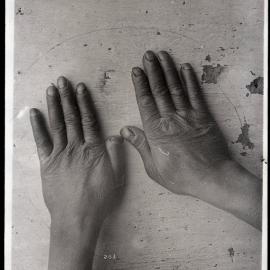 Yeung Tsung's Hands - Imaged Used to Disprove Leprosy